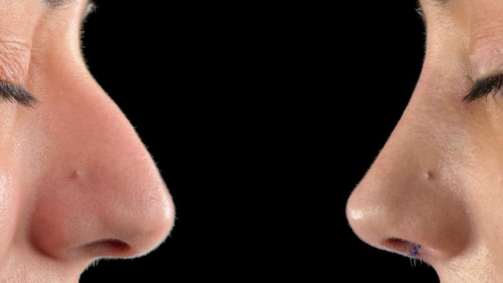 mujer antes y después de rinoplastia ultrasonica realizada por el Dr. Pérez Villar