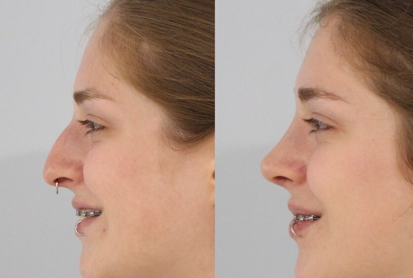 Resultados reales. Antes y después de rinoplastia ultrasónica.