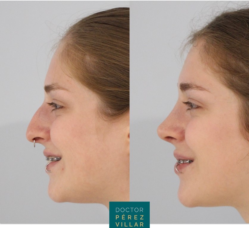 Resultados reales. Antes y después de rinoplastia ultrasónica.