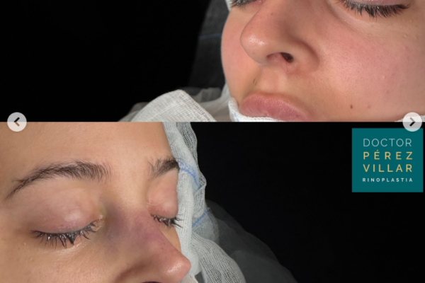 Antes y después de rinoseptoplastia ultrasonica