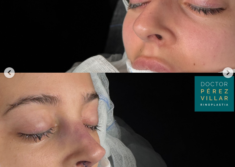 Antes y después de rinoseptoplastia ultrasonica