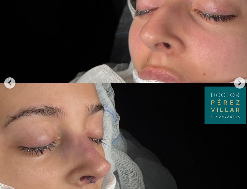 Antes y después de rinoseptoplastia ultrasonica