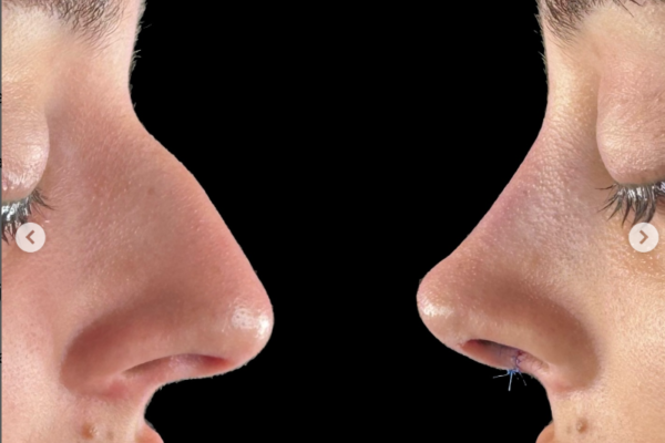 antes-despues-rinopeptoplastia-ultrasonica