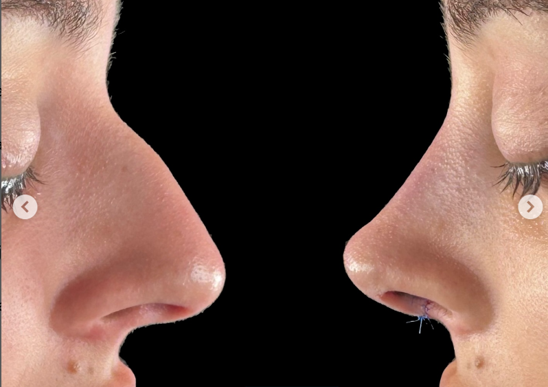 antes-despues-rinopeptoplastia-ultrasonica