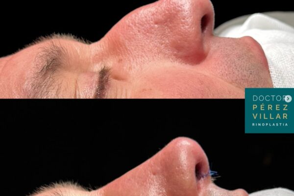 Operación del caballete nasal con rinoplastia