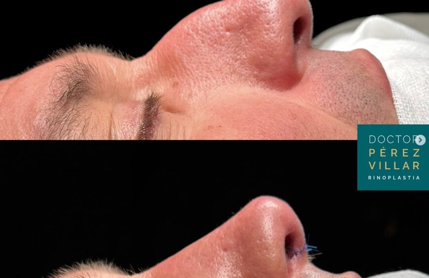 Operación del caballete nasal con rinoplastia