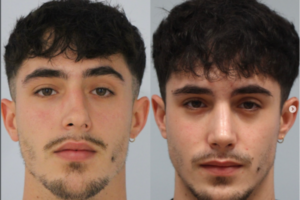 laterorrinia, tratada con rinoplastia ultrasónica. Antes y después.