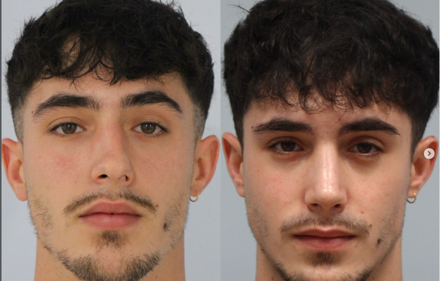 laterorrinia, tratada con rinoplastia ultrasónica. Antes y después.