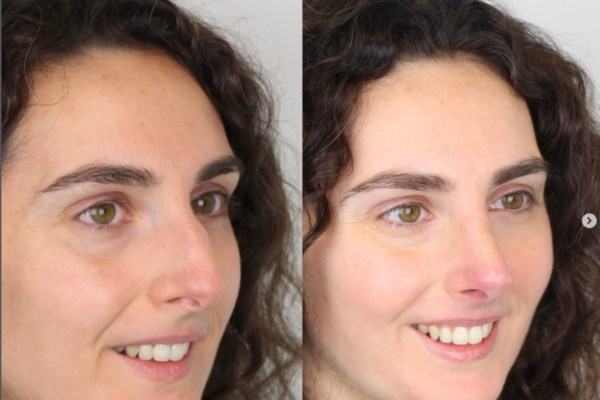 rinoplastia perfil tres cuartos