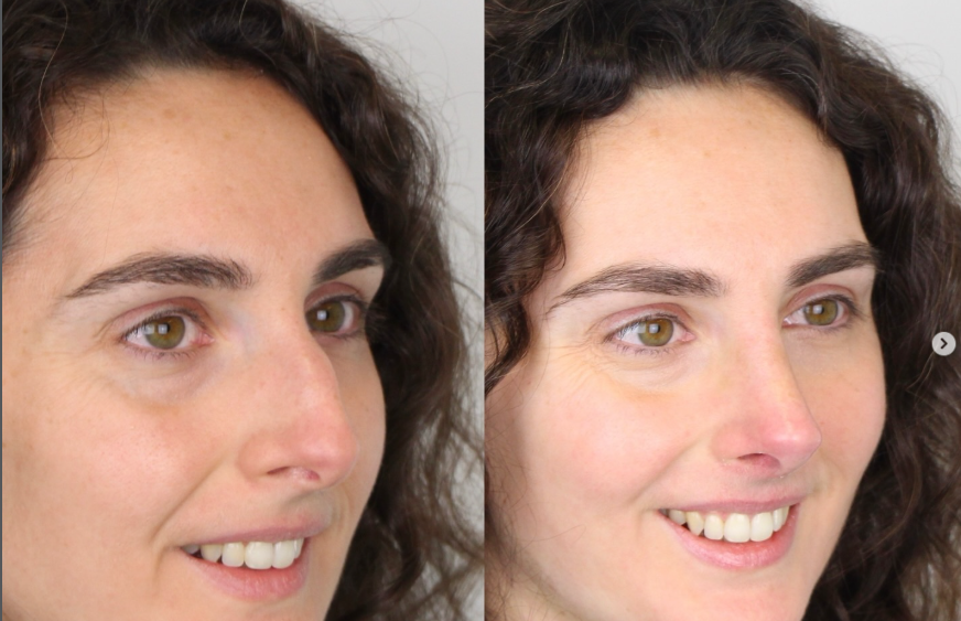 rinoplastia perfil tres cuartos