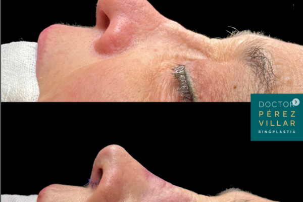 Reconstrucción nasal avanzada con injerto de costilla: caso real de rinoplastia secundaria