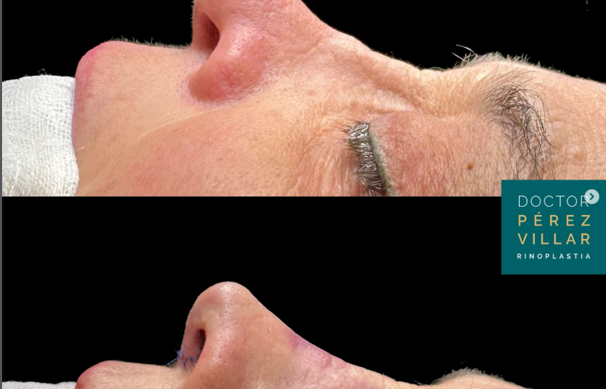 Reconstrucción nasal con injerto de costilla - Caso Real