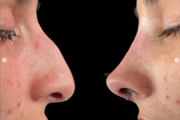 Caso Real: Corrección de giba nasal con rinoplastia ultrasónica