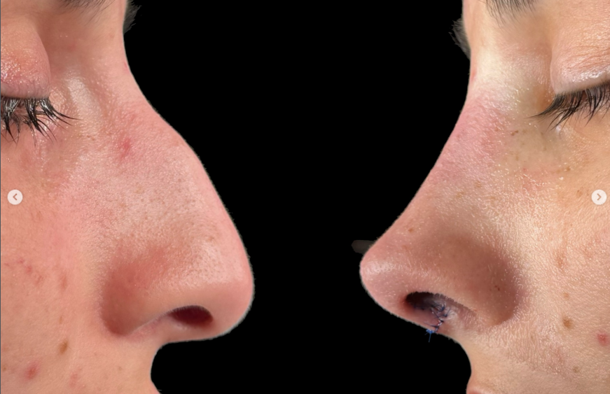 Corrección giba nasal en Valladolid