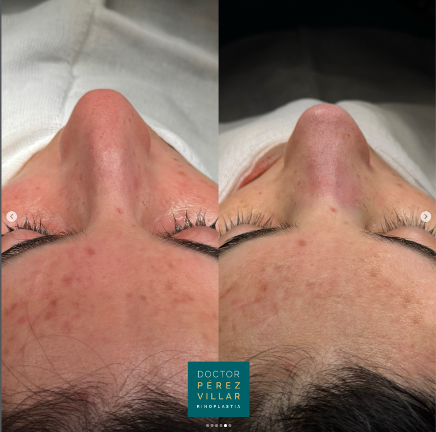 Dorsal Hump Correction with Ultrasonic Rhinoplasty