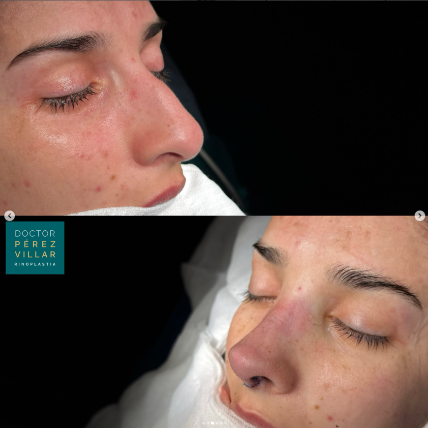 Caso Real de rinoplastia ultrasónica: antes y después de cirugía para corregir giba nasal