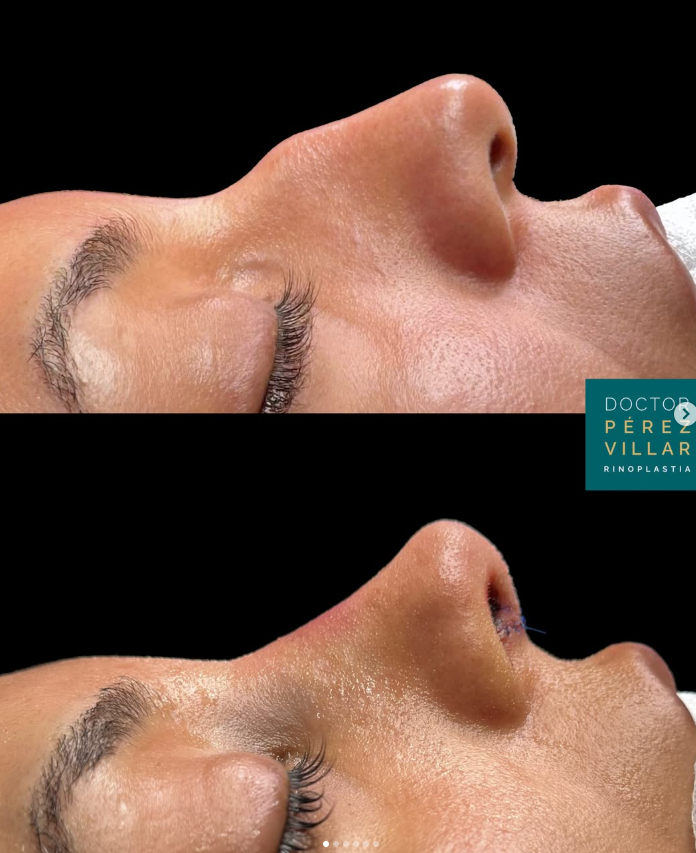 Antes y después inmediato de una rinoplastia ultrasónica, fotografiado en la misma intervención